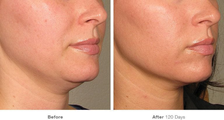 Chin slimming before and after using GlowBeam