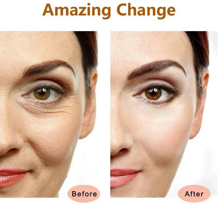 Eye & cheek wrinkles before and after using GlowBeam